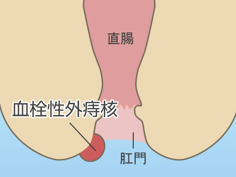 血栓性外痔核とは