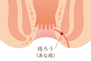 痔ろうについて